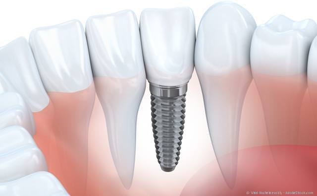 Implantat mit Krone