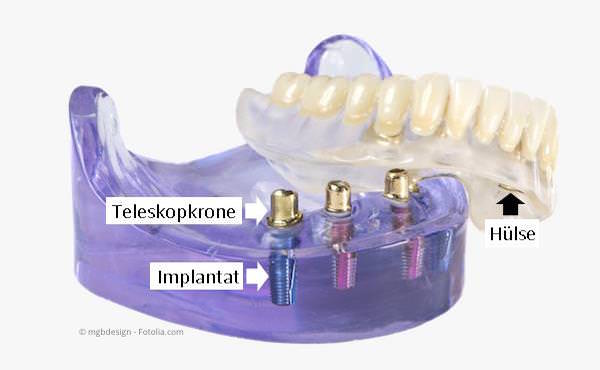 Sicherer Prothesensitz mit nur wenigen Implantaten