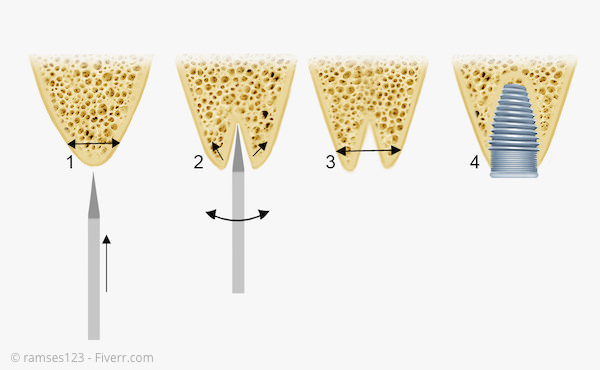 Bone Spreading: Ein zu schmaler Kieferkamm wird im Bereich des Implantats verbreitert.