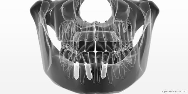 3D-Navigation bei der Implantologie